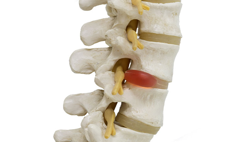 imagem de uma coluna cervical com hérnia de disco