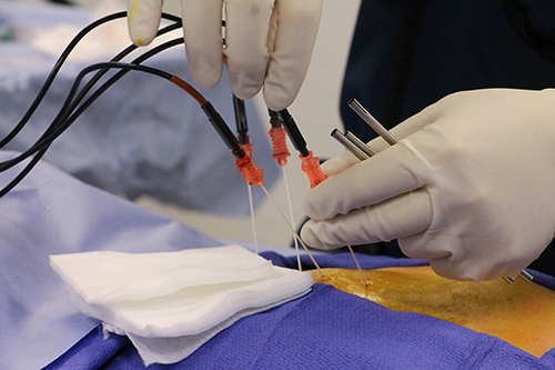 Rizotomia por radiofrequência: recomendações e cuidados