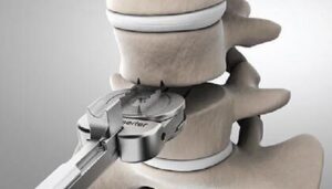Técnica de Artroplastia Vertebral
