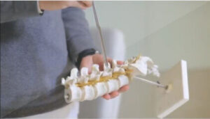 Técnica de Cifoplastia da Neurosafe