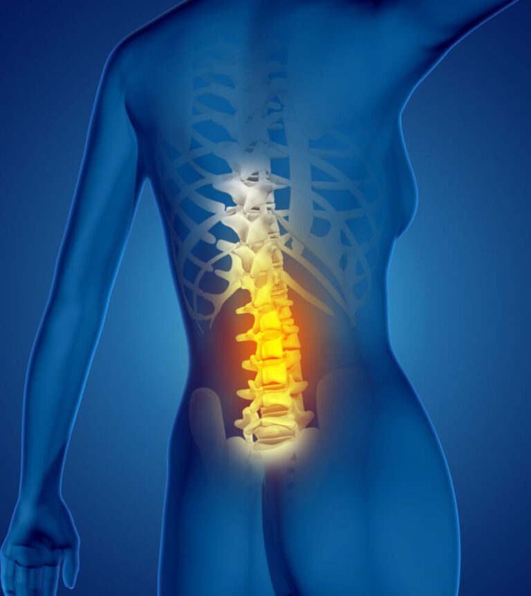 Sou candidato? Sinais de que a Descompressão Discal a Laser ou Descompressão Percutânea a Laser podem ajudar